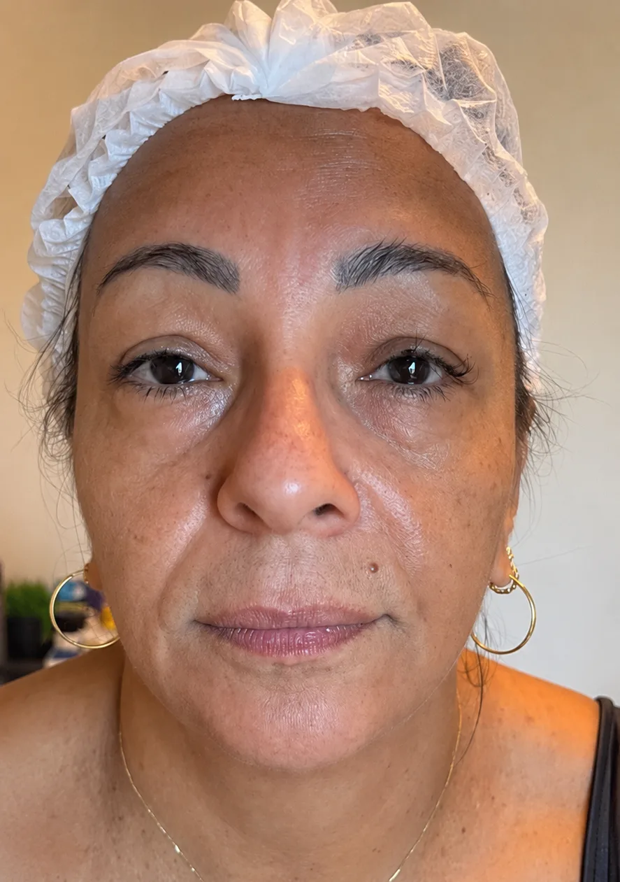 Lábios antes do preenchimento labial com ácido hialurônico