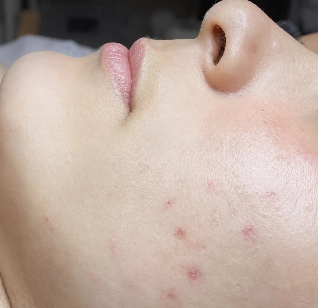 Lábios antes do preenchimento labial com ácido hialurônico