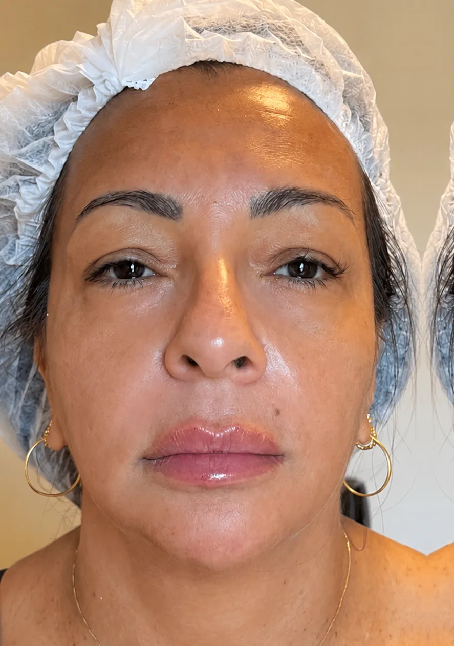 Lábios após o preenchimento labial, com contorno valorizado e volume equilibrado