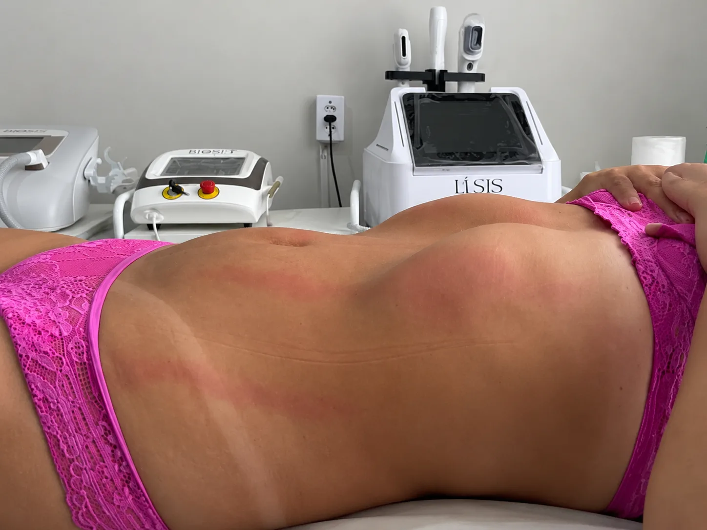 Região abdominal após o procedimento corporal, com aparência mais uniforme e harmônica